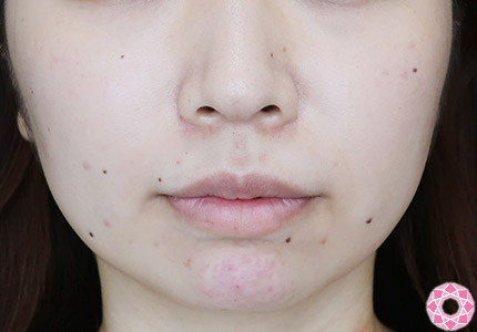 年代：20代 施術名：ジュビダーム 施術後｜【公式】東京形成美容外科