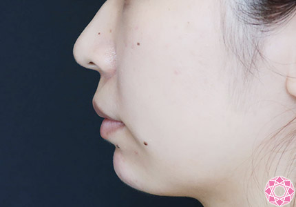 年代：20代 施術名：ジュビダーム 施術後｜【公式】東京形成美容外科