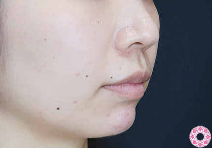 年代：20代 施術名：ジュビダーム 施術後｜【公式】東京形成美容外科