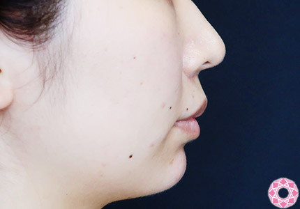 年代：20代 施術名：ジュビダーム 施術後｜【公式】東京形成美容外科