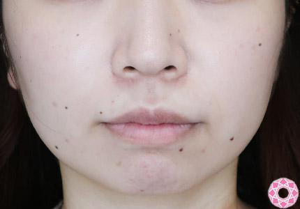 年代：20代 施術名：ジュビダーム 施術前｜【公式】東京形成美容外科