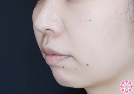 年代：20代 施術名：ジュビダーム 施術前｜【公式】東京形成美容外科