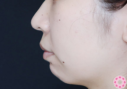 年代：20代 施術名：ジュビダーム 施術前｜【公式】東京形成美容外科