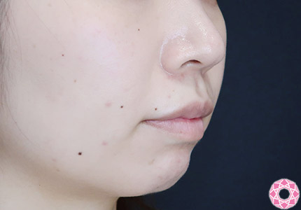 年代：20代 施術名：ジュビダーム 施術前｜【公式】東京形成美容外科