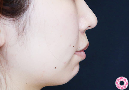 年代：20代 施術名：ジュビダーム 施術前｜【公式】東京形成美容外科