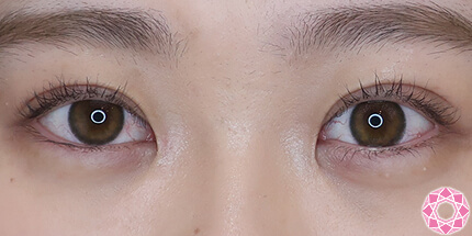 年代：20代 施術名：二重埋没法 施術後｜【公式】東京形成美容外科