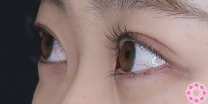 年代：20代 施術名：二重埋没法 施術後｜【公式】東京形成美容外科