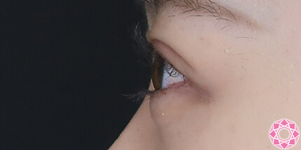 年代：20代 施術名：二重埋没法 施術後｜【公式】東京形成美容外科