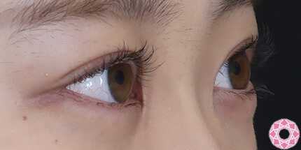 年代：20代 施術名：二重埋没法 施術後｜【公式】東京形成美容外科