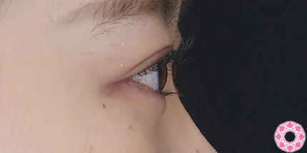 年代：20代 施術名：二重埋没法 施術後｜【公式】東京形成美容外科