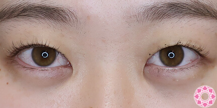 年代：20代 施術名：二重埋没法 施術前｜【公式】東京形成美容外科