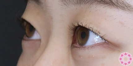 年代：20代 施術名：二重埋没法 施術前｜【公式】東京形成美容外科