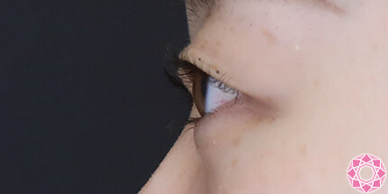 年代：20代 施術名：二重埋没法 施術前｜【公式】東京形成美容外科