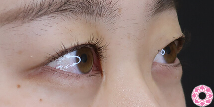 年代：20代 施術名：二重埋没法 施術前｜【公式】東京形成美容外科