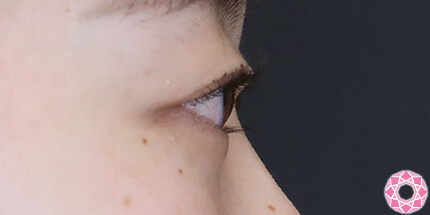 年代：20代 施術名：二重埋没法 施術前｜【公式】東京形成美容外科