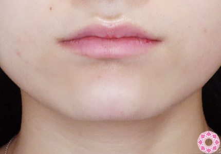 年代：20代 施術名：ジュビダーム 施術後｜【公式】東京形成美容外科