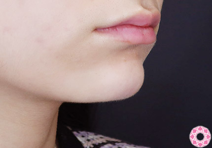 年代：20代 施術名：ジュビダーム 施術後｜【公式】東京形成美容外科