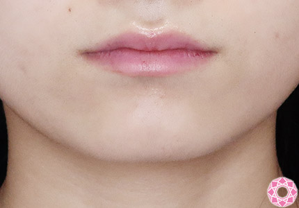 年代：20代 施術名：ジュビダーム 施術前｜【公式】東京形成美容外科