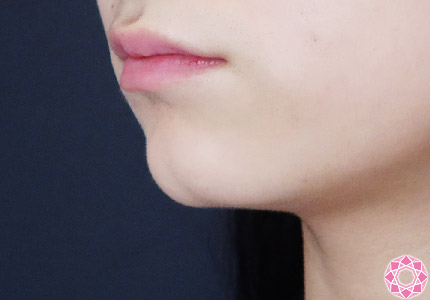 年代：20代 施術名：ジュビダーム 施術前｜【公式】東京形成美容外科