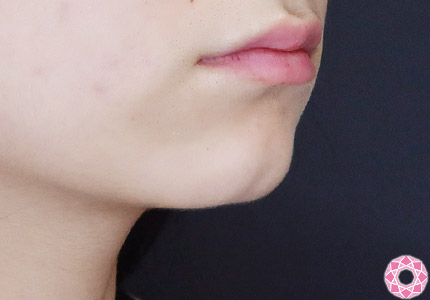 年代：20代 施術名：ジュビダーム 施術前｜【公式】東京形成美容外科