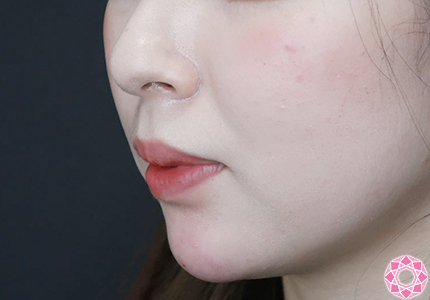 年代：20代 施術名：アゴのヒアルロン酸注入 施術後｜【公式】東京形成美容外科