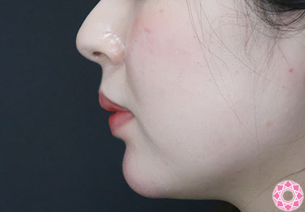 年代：20代 施術名：アゴのヒアルロン酸注入 施術後｜【公式】東京形成美容外科