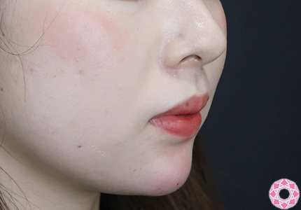 年代：20代 施術名：アゴのヒアルロン酸注入 施術後｜【公式】東京形成美容外科