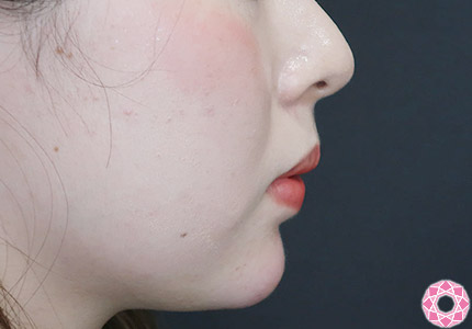 年代：20代 施術名：アゴのヒアルロン酸注入 施術後｜【公式】東京形成美容外科