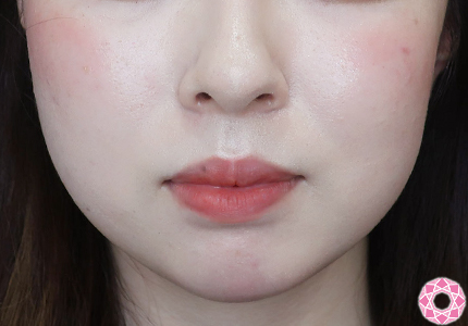 年代：20代 施術名：アゴのヒアルロン酸注入 施術前｜【公式】東京形成美容外科