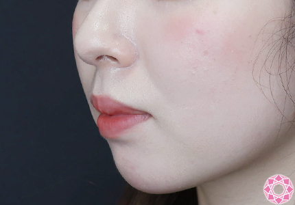 年代：20代 施術名：アゴのヒアルロン酸注入 施術前｜【公式】東京形成美容外科