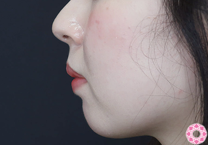 年代：20代 施術名：アゴのヒアルロン酸注入 施術前｜【公式】東京形成美容外科