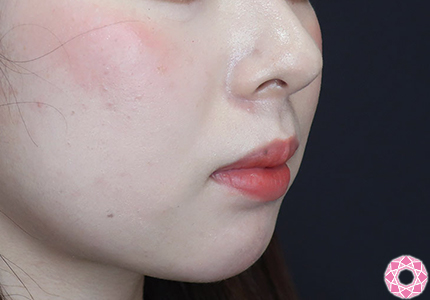 年代：20代 施術名：アゴのヒアルロン酸注入 施術前｜【公式】東京形成美容外科