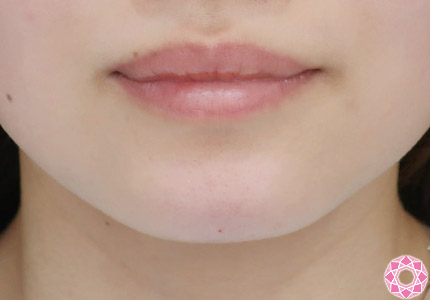 年代：20代 施術名：アゴのヒアルロン酸注入 施術後｜【公式】東京形成美容外科