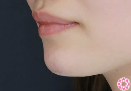 年代：20代 施術名：アゴのヒアルロン酸注入 施術後｜【公式】東京形成美容外科