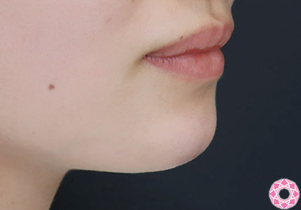 年代：20代 施術名：アゴのヒアルロン酸注入 施術後｜【公式】東京形成美容外科