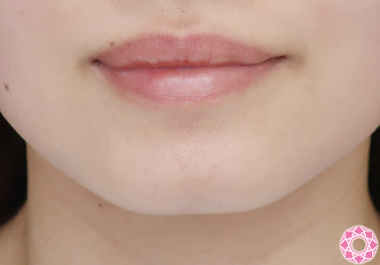 年代：20代 施術名：アゴのヒアルロン酸注入 施術前｜【公式】東京形成美容外科