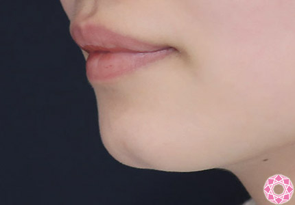 年代：20代 施術名：アゴのヒアルロン酸注入 施術前｜【公式】東京形成美容外科