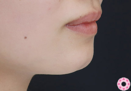 年代：20代 施術名：アゴのヒアルロン酸注入 施術前｜【公式】東京形成美容外科