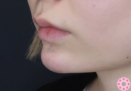 年代：20代 施術名：ジュビダーム 施術後｜【公式】東京形成美容外科