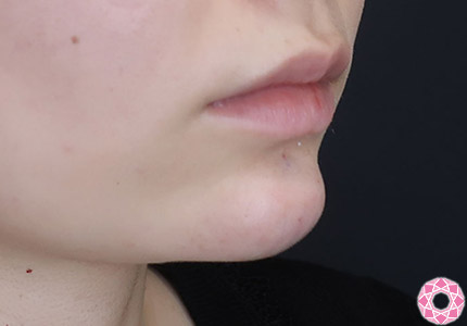 年代：20代 施術名：ジュビダーム 施術後｜【公式】東京形成美容外科