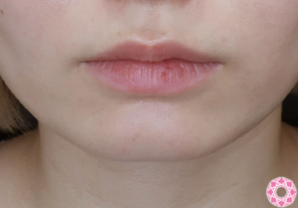 年代：20代 施術名：ジュビダーム 施術前｜【公式】東京形成美容外科