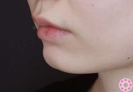 年代：20代 施術名：ジュビダーム 施術前｜【公式】東京形成美容外科
