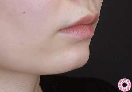 年代：20代 施術名：ジュビダーム 施術前｜【公式】東京形成美容外科