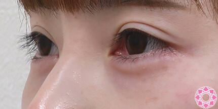 年代：20代 施術名：ジュビダーム 施術後｜【公式】東京形成美容外科