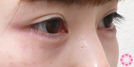 年代：20代 施術名：ジュビダーム 施術後｜【公式】東京形成美容外科