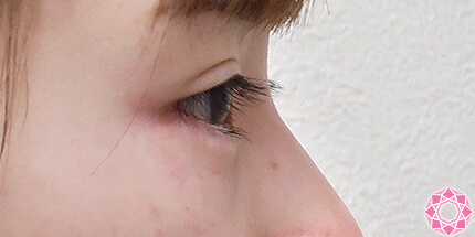 年代：20代 施術名：ジュビダーム 施術後｜【公式】東京形成美容外科