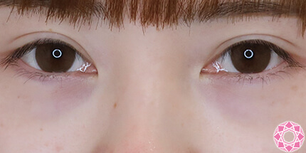 年代：20代 施術名：ジュビダーム 施術前｜【公式】東京形成美容外科