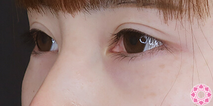 年代：20代 施術名：ジュビダーム 施術前｜【公式】東京形成美容外科