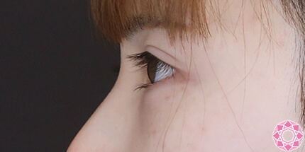 年代：20代 施術名：ジュビダーム 施術前｜【公式】東京形成美容外科