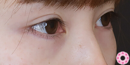 年代：20代 施術名：ジュビダーム 施術前｜【公式】東京形成美容外科